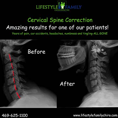 Chiropractic McKinney TX Cervical Spine Correction